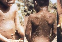 แคนาดา ยันพบผู้ติดเชื้อ ‘ฝีดาษลิง’ ครั้งแรกในประวัติศาสตร์